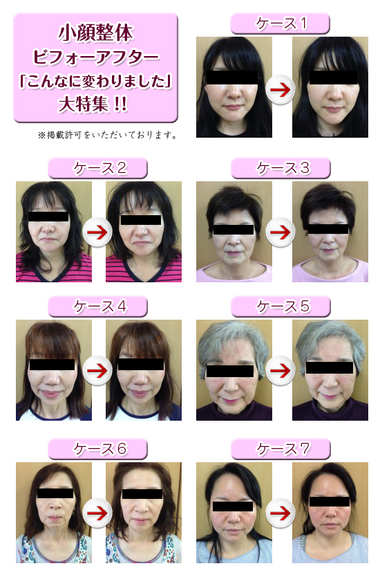 小顔整体ビフォーアフター 小顔整体ビフォーアフター