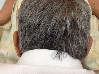 Sさん施術前 Sさん施術前