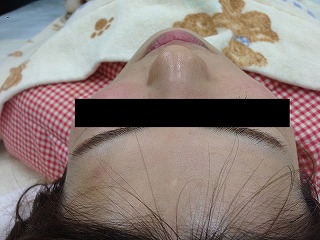Nさん施術前 Nさん施術前